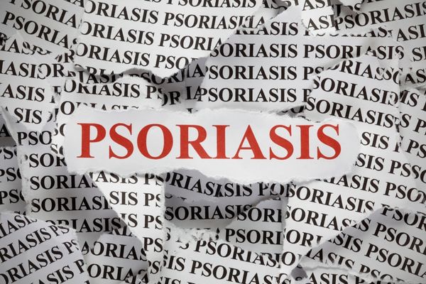 The word psoriasis on ripped up newspaper for Psoriasis Awareness Month