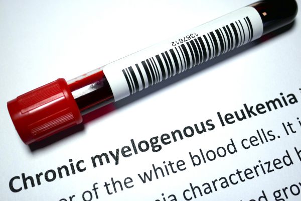 Blood test for Chronic Myeloid Leukemia (CML)